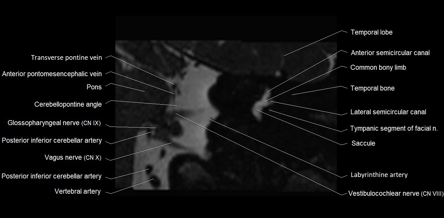 MRI Internal auditory meatus (IAM) coronal cross sectional labelled anatomy image 17.webp